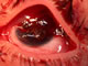 Severe corneal laceration