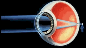 Hypermetropia (Long-sight)