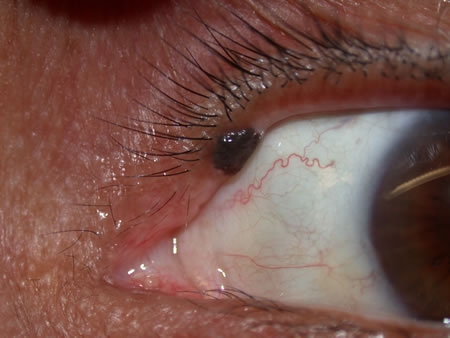 papilloma eyelid