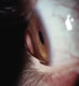 Keratoconus