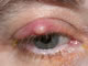 Inflamed cyst