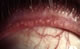 Posterior blepharitis
