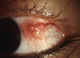 Episcleritis