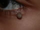 Papilloma