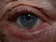 Lower lid entropion
