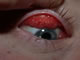Severe conjunctival inflammation