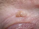 Seborrhoeic keratosis