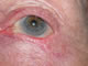 Post operation - ectropion due to lower eyelid scarring