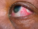 Episcleritis