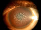 Macula corneal dystrophy