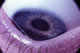 Keratoconus