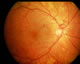 Prolferative retinopathy and previous laser treatment