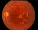 Background retinopathy
