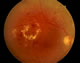 Background retinopathy and maculopathy