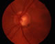 Early glaucomatous damage