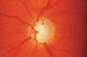 Advanced glaucoma, severe loss of optic nerve fibres