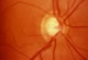 Normal optic nerve appearance in eye with healthy outer ring of optic nerve fibres