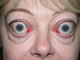 Severe thyroid eye disease