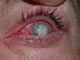 Severe contact lens-related bacterial keratitis