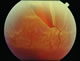 Upper retinal detachment with tear clearly visible