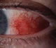 Patch of scleral inflammation