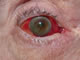 Severe sub-conjunctive haemorrhage