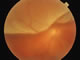 Upper retinal detachment